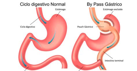 bypass gástrico